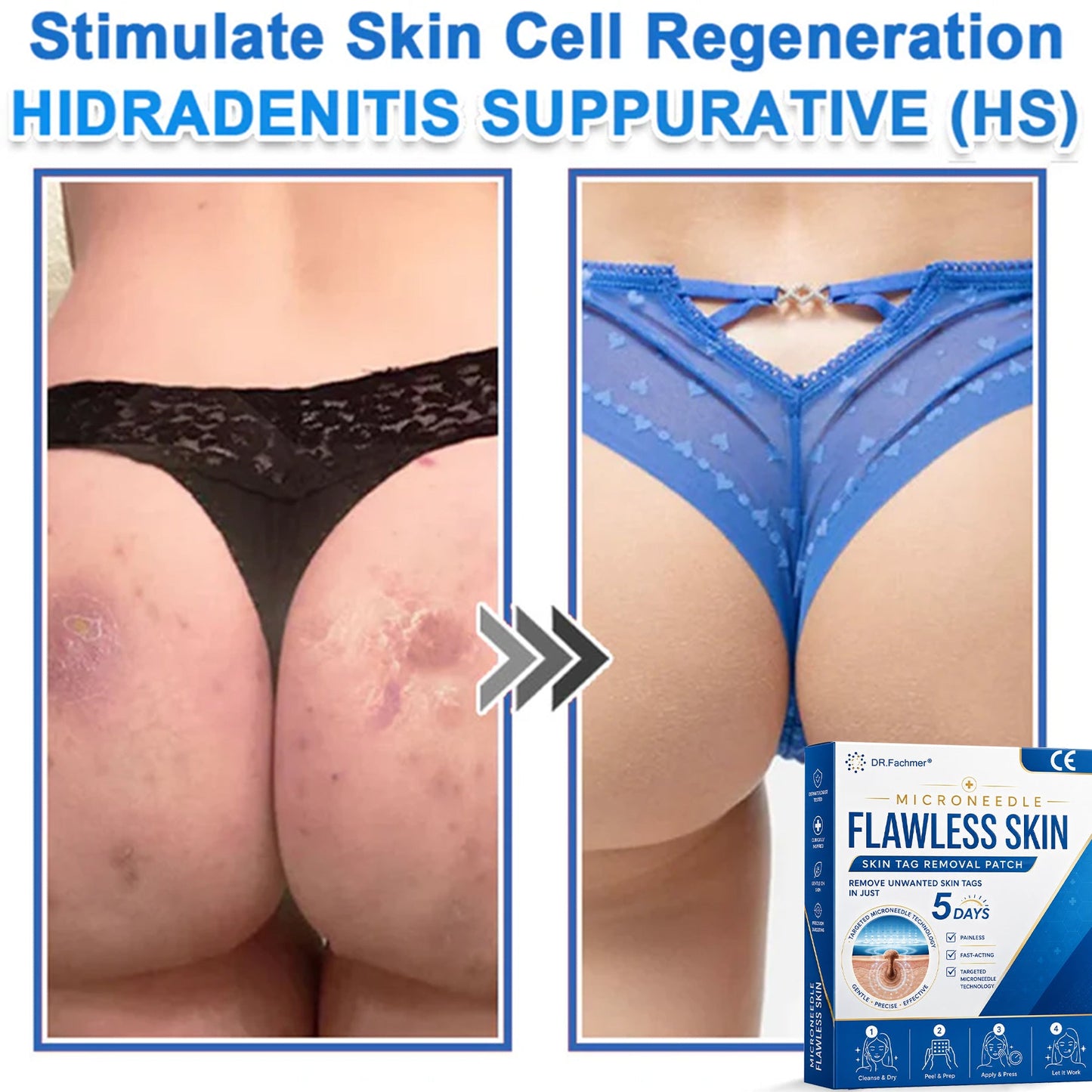 ✅ DR.Fachmer® 2-in-1 Microneedle & Hydrocolloid Patch 🌿| Raised Moles,Acne,  Flat Warts & Skin Tags Remover | Improves Wrinkles, Scars & Blemishes | Invisible Pimple Patches for Face & Body