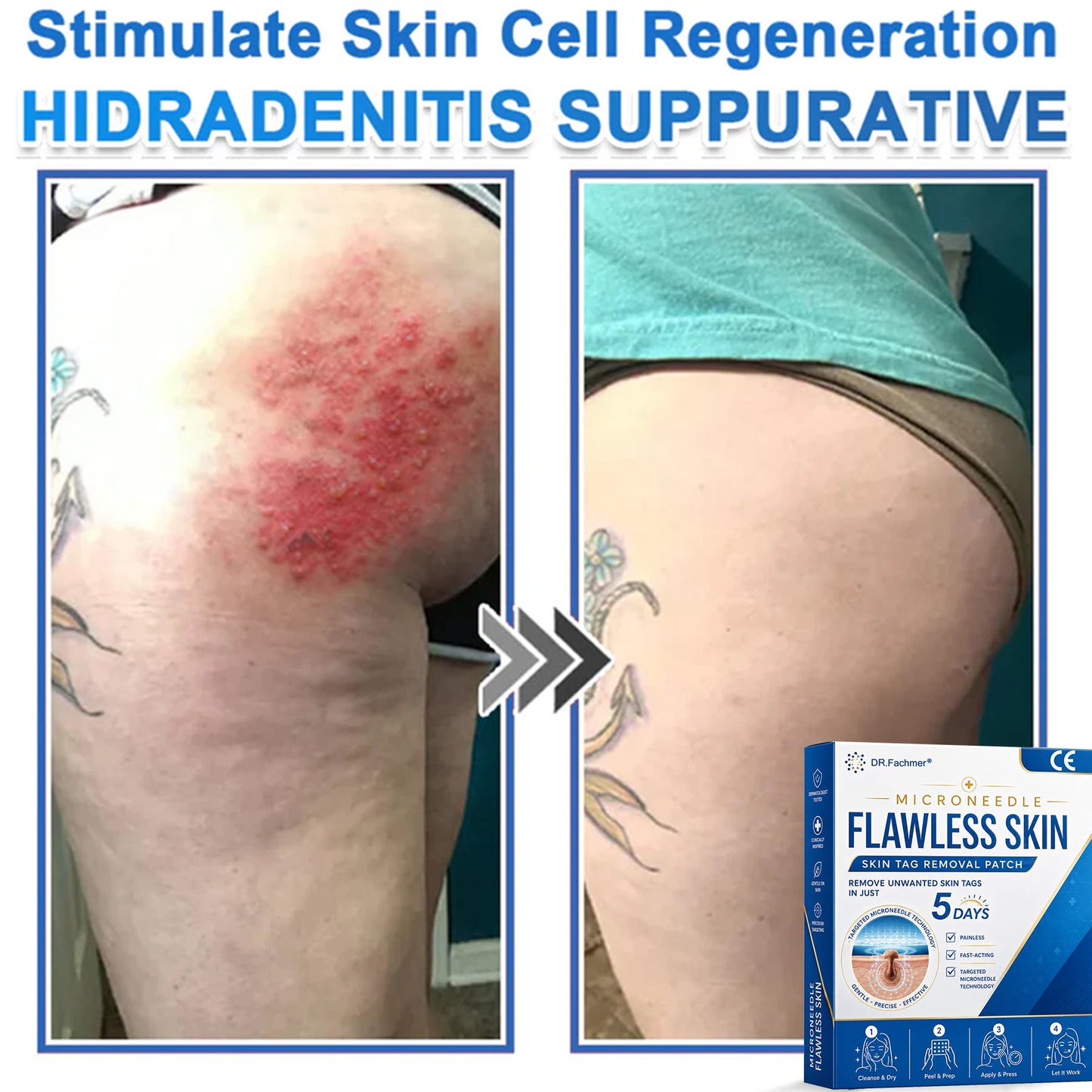✅ DR.Fachmer® 2-in-1 Microneedle & Hydrocolloid Patch 🌿| Raised Moles,Acne,  Flat Warts & Skin Tags Remover | Improves Wrinkles, Scars & Blemishes | Invisible Pimple Patches for Face & Body