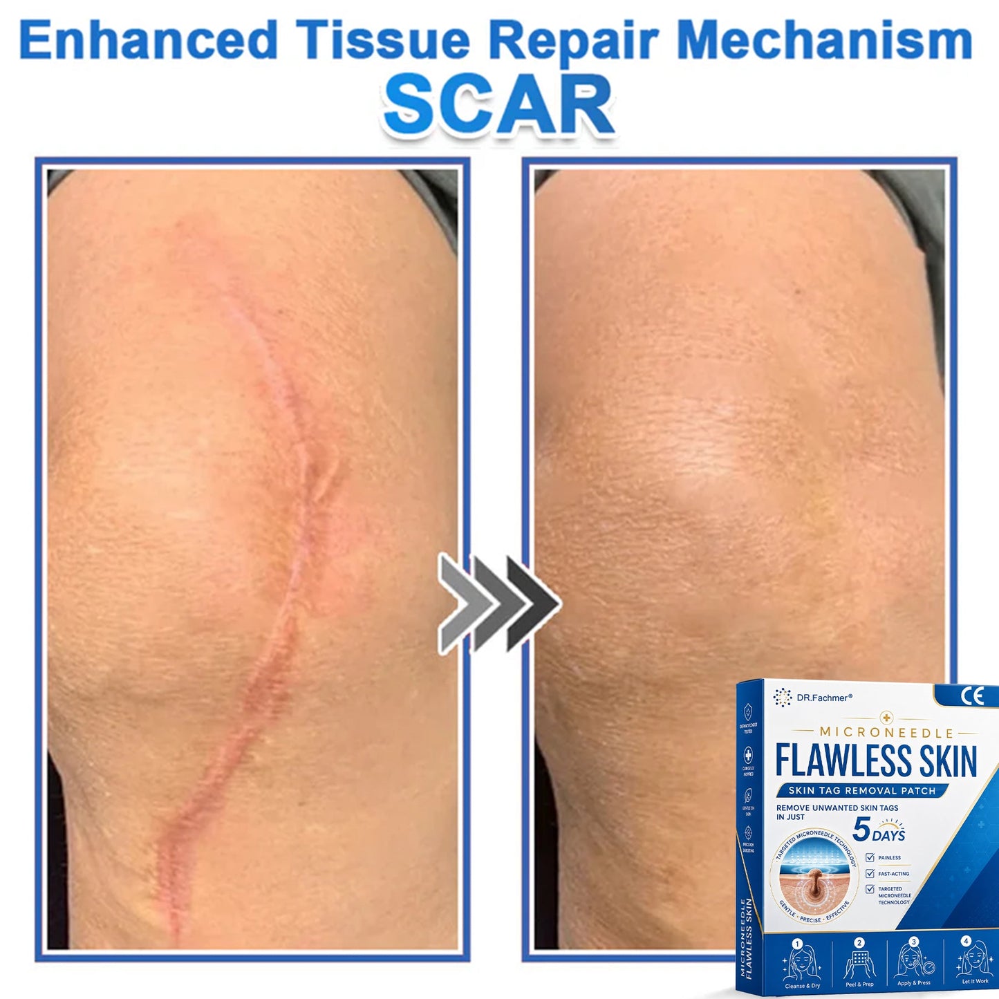✅ DR.Fachmer® 2-in-1 Microneedle & Hydrocolloid Patch 🌿| Raised Moles,Acne,  Flat Warts & Skin Tags Remover | Improves Wrinkles, Scars & Blemishes | Invisible Pimple Patches for Face & Body