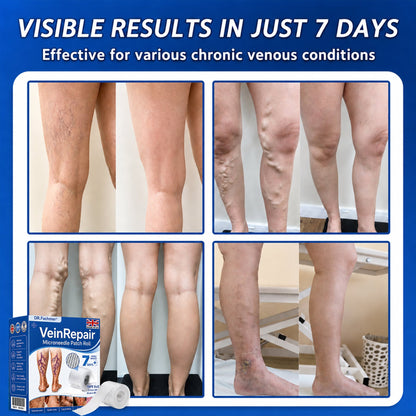 🩹DR.Fachmer® Vein Ease Microneedle Care Patch(For Spider Veins, Varicose Veins, Swelling & Leg Fatigue) - Last Day Promotion 50% OFF