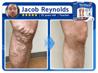 🌿DR.Fachmer® Vein Ease Microneedle Care Patch(For Spider Veins, Varicose Veins, Swelling & Leg Fatigue) - Last Day Promotion 50% OFF