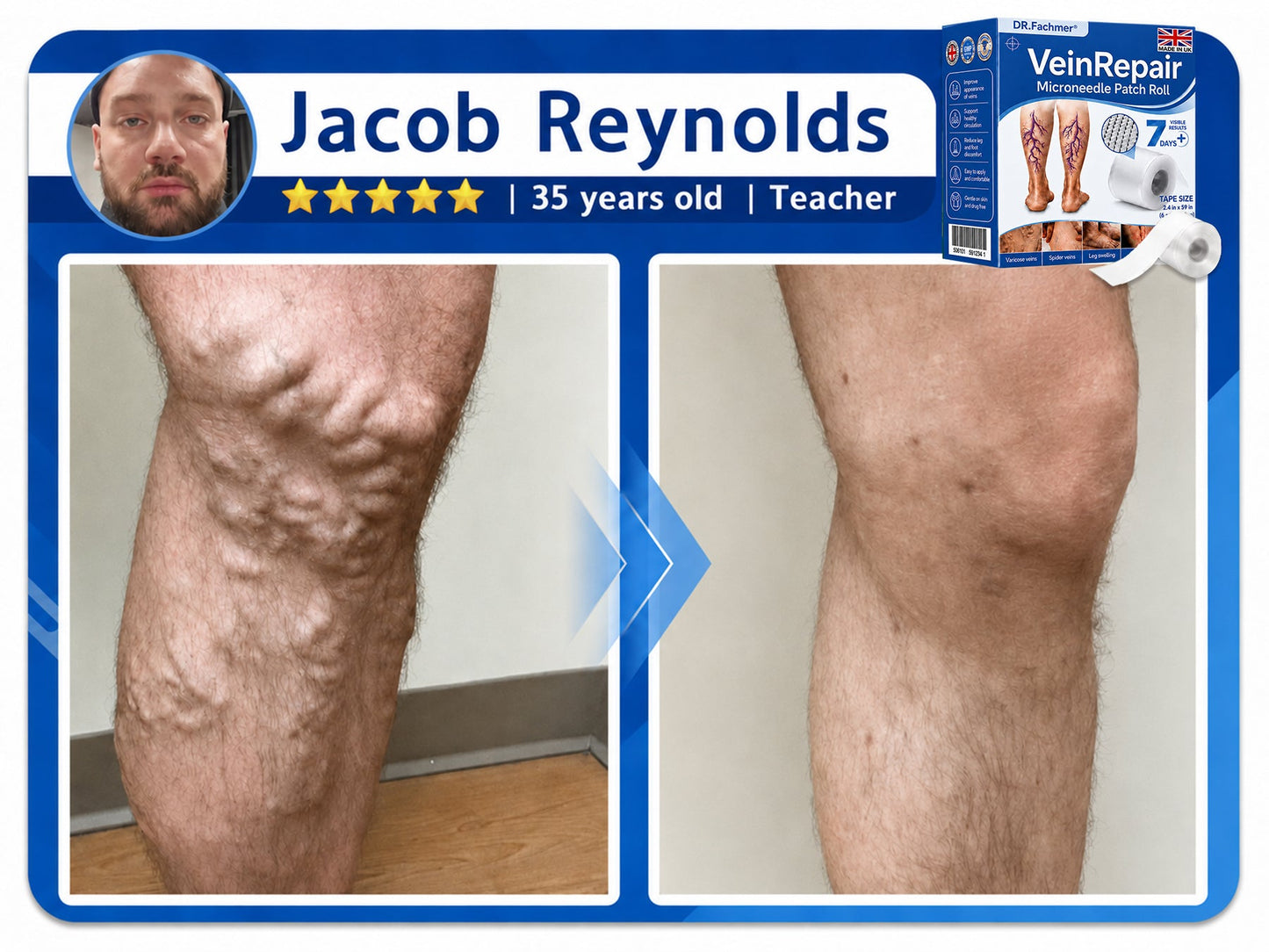 🦵DR.Fachmer® Vein Ease Microneedle Care Patch(For Spider Veins, Varicose Veins, Swelling & Leg Fatigue) - Last Day Promotion 50% OFF