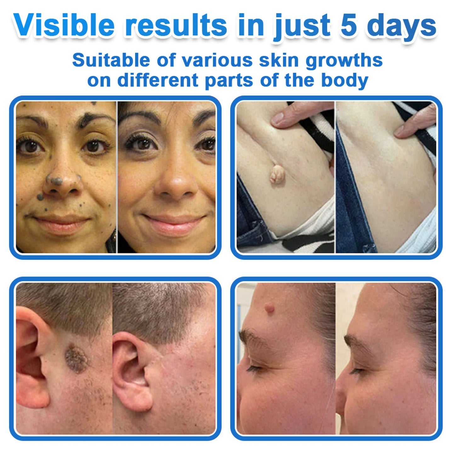✅ DR.Fachmer® 2-in-1 Microneedle & Hydrocolloid Patch 🌿| Raised Moles,Acne,  Flat Warts & Skin Tags Remover | Improves Wrinkles, Scars & Blemishes | Invisible Pimple Patches for Face & Body