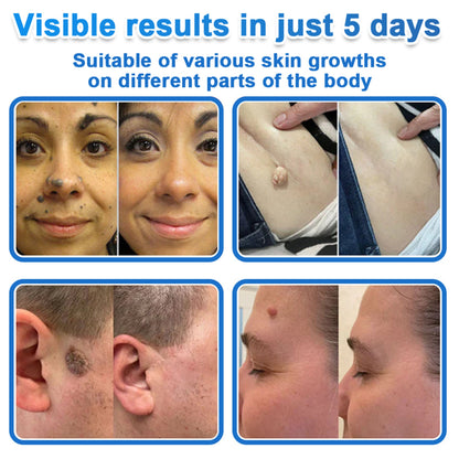 ✅ DR.Fachmer® 2-in-1 Microneedle & Hydrocolloid Patch 🌿| Raised Moles,Acne,  Flat Warts & Skin Tags Remover | Improves Wrinkles, Scars & Blemishes | Invisible Pimple Patches for Face & Body