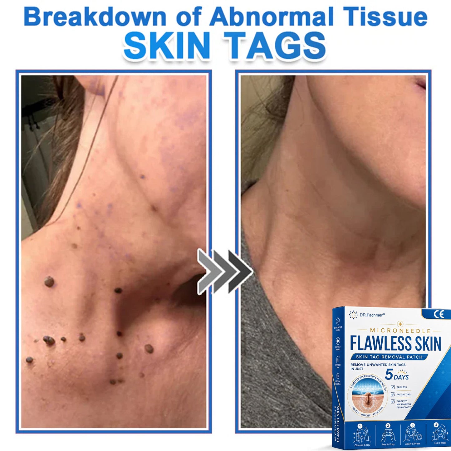 ✅ DR.Fachmer® 2-in-1 Microneedle & Hydrocolloid Patch 🌿| Raised Moles,Acne,  Flat Warts & Skin Tags Remover | Improves Wrinkles, Scars & Blemishes | Invisible Pimple Patches for Face & Body