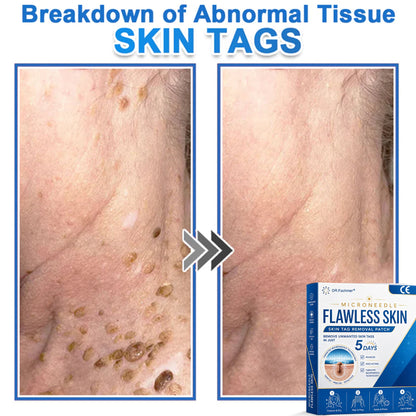 ✅ DR.Fachmer® 2-in-1 Microneedle & Hydrocolloid Patch 🌿| Raised Moles,Acne,  Flat Warts & Skin Tags Remover | Improves Wrinkles, Scars & Blemishes | Invisible Pimple Patches for Face & Body