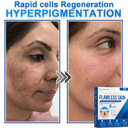 ✅ DR.Fachmer® 2-in-1 Microneedle & Hydrocolloid Patch 🌿| Raised Moles,Acne,  Flat Warts & Skin Tags Remover | Improves Wrinkles, Scars & Blemishes | Invisible Pimple Patches for Face & Body
